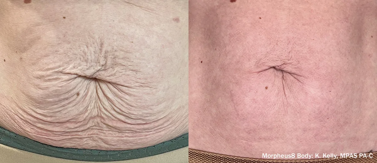 Morpheus8 before and after, Abdomen