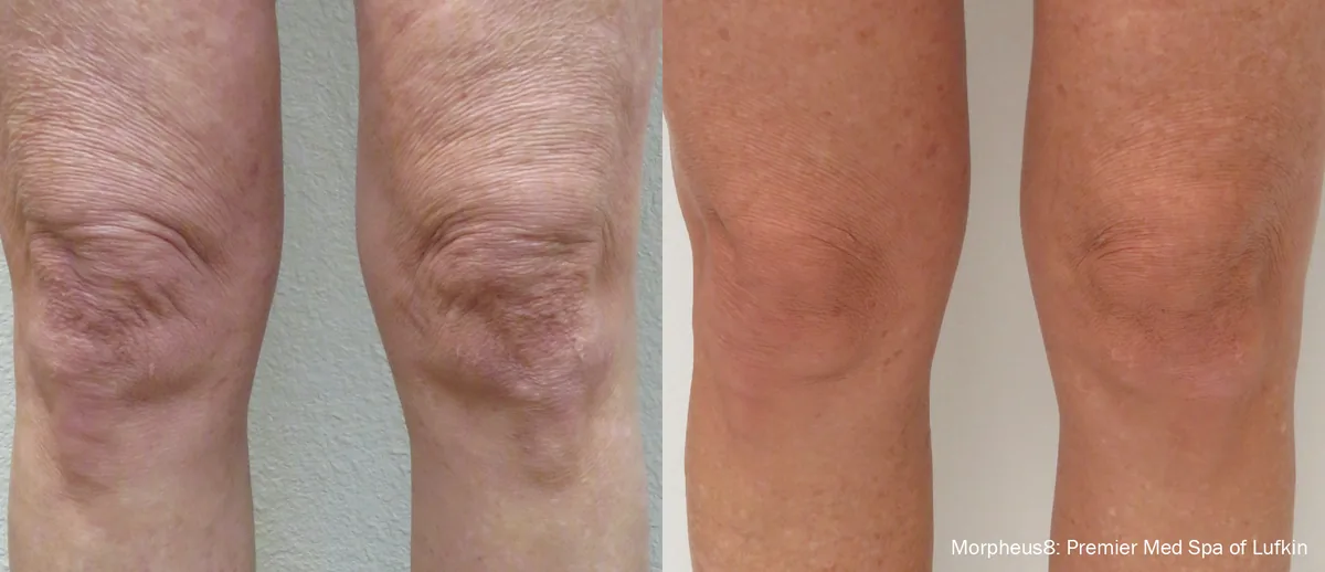 Morpheus8 before and after, Knees